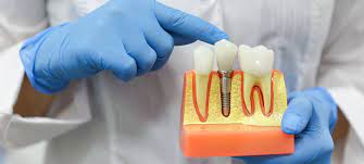 the cost of dental implants in toronto