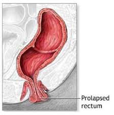 reducing a rectal prolapse