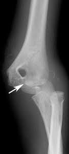 They are much rarer than medial epicondyle fractures and represent avulsion of the lateral epicondyle. Clinical Practice Guidelines Medial Epicondyle Fracture Of The Humerus Emergency Department
