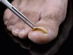 garlic a toenail fungus remedy