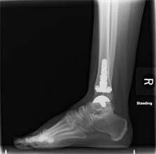 what is total ankle replacement