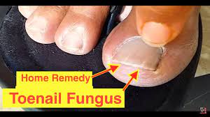 home remedy cure for toenail fungus