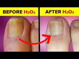 treat nail fungus with hydrogen