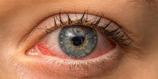 eye redness moorfields eye hospitals uae