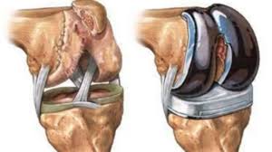 total knee replacement don t skip