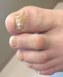 thick yellow toenails causes home