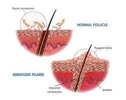 treatment for keratosis pilaris