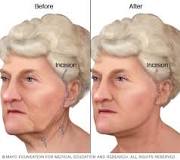 Face-lift - Mayo Clinic