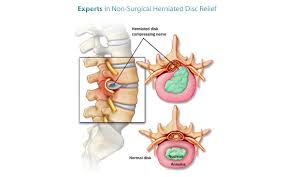 herniated discs treatment chicago