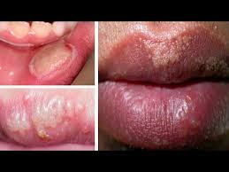 fordyce spots on lips overnight
