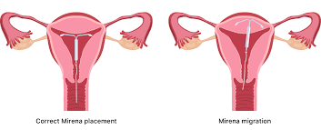 mirena iud side effects weight gain