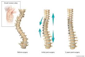 treating scoliosis with vertebral body