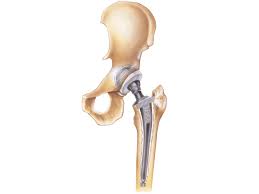 hip replacement complications risk of