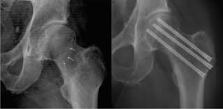 fem neck fractures in the elderly