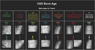 A New Validated Shorthand Method For Determining Bone Age