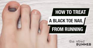 bruised or black toenail from running