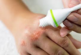 Eczema Treatment, Cream, Types (Dyshidrotic, Baby), Causes, Symptoms