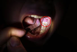 swollen wisdom tooth gum causes signs