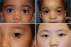 benign pediatric eyelid tumors