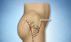 mini posterior and direct anterior