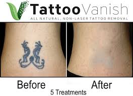 non laser tattoo removal