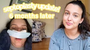 my septoplasty update 6 months later
