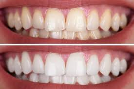 teeth whitening in union city nj