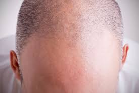 A postoperative evaluation is scheduled at five months at which time the expectation is the visualization of early new transplant growth. Hair Transplant Monthly Growth New York Ny Graft Healing Process