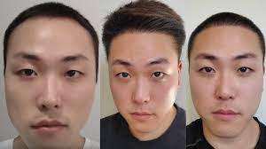 Microneedling is a procedure that uses tiny needles placed in a face roller or automated pen to puncture the very first layer of skin. Crazy Microneedling Results To Stop Balding And Hair Loss Youtube