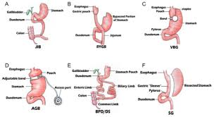 bariatric surgery on metabolic diseases