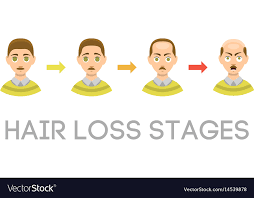 Information Chart Of Hair Loss Stages Types Of