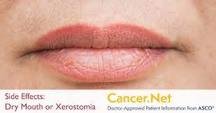 dry mouth or xerostomia cancer net