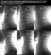 cervical spine realignment and