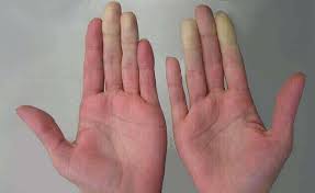 finger numbness numb fingers left hand