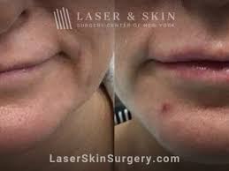 dermal filler injections new york ny