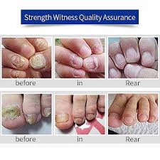 qianfoot nail fungus treatment serum