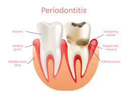 periodonis gum disease treatment