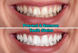 As you age, tartar begins to build up in your mouth faster and faster. Prevent Remove Teeth Stains Regent Dental Cambridge