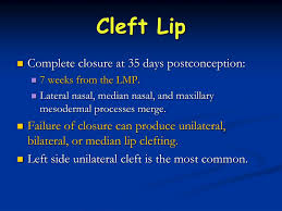 ppt cleft lip palate powerpoint