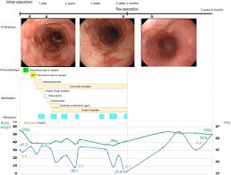 severe reflux esophagitis after total