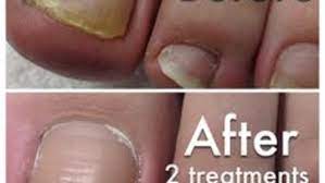 fungal nail infection removal rachels
