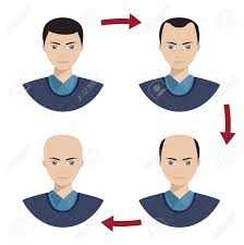Information Chart Showing Four Stages Of Hair Loss For Men Bolding