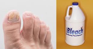toenail fungus with bleach prevention