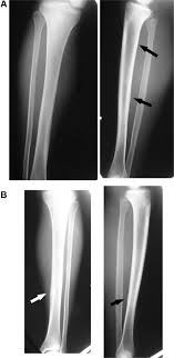 posterior tibial stress fracture
