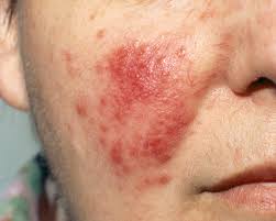7 causes of red spots and ps on skin