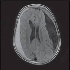 Intracranial subdural hematomas and cerebral herniation after labor epidural with no evidence of dural puncture. Recurrent Chronic Subdural Hematoma Report Of 13 Cases