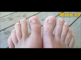 Yet another easy treatment for toenail fungus that gives outstanding results. Mentholatum Toenail Fungus Gnats Mentholatum
