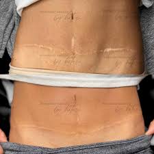 tummy tuck scar camouflage most