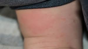 22 common skin rashes pictures causes