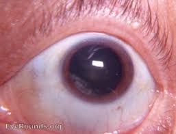 Incipient Cortical Cataract The Inferior Nasal Quadrant